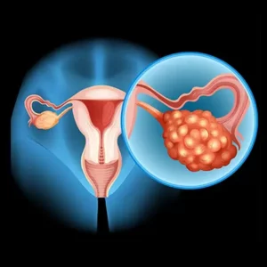 Read more about the article PCOD: एक गंभीर समस्या, लेकिन समाधान है आपके हाथों में!