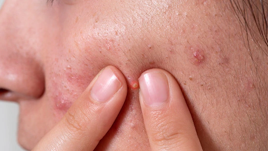 You are currently viewing पिंपल्स को कहें अलविदा! अपनाएं ये असरदार घरेलू नुस्खे