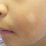 बच्चों के चेहरे पर दिखने वाले सफेद दाग – क्या ये गंभीर बीमारी है या केवल स्किन ड्रायनेस का संकेत? जानिए सच, सावधानी और समाधान